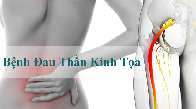 Người bị đau thần kinh tọa uống thuốc gì mới tốt