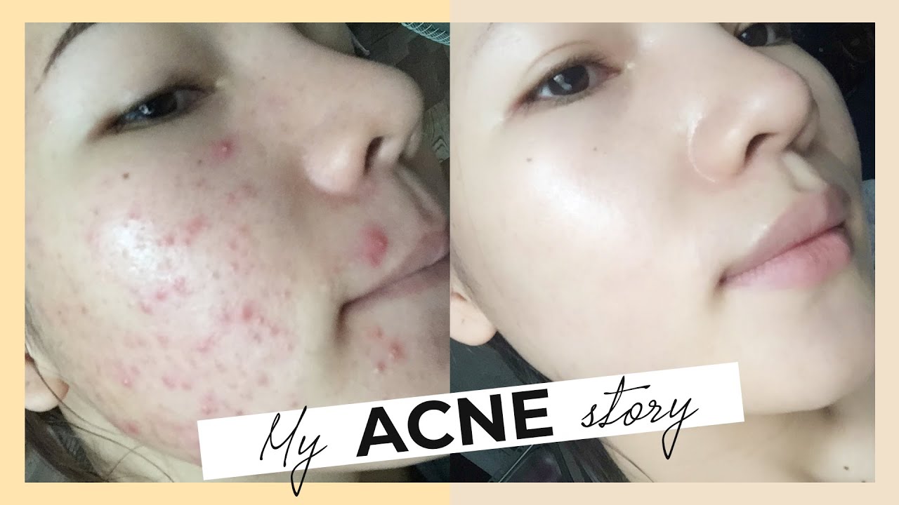 SKINCARE VÀ CHẾ ĐỘ SINH HOẠT KHI BỊ MỤN | NHẬT KÝ TRỊ MỤN TỪ A – Z CỦA CHANG