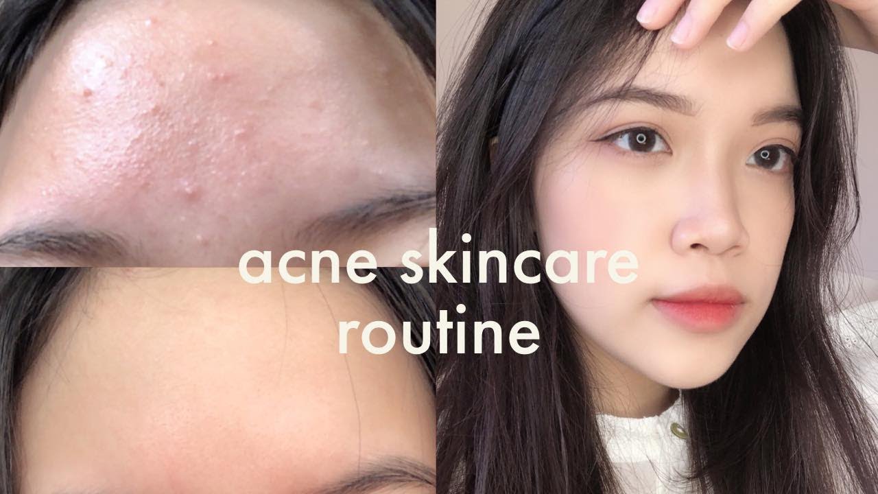 Skincare Routine | MÌNH ĐÃ TRỊ MỤN ẨN NHƯ THẾ NÀO? | HOW TO TREAT COMEDONE ACNE? | Coanh Coanh