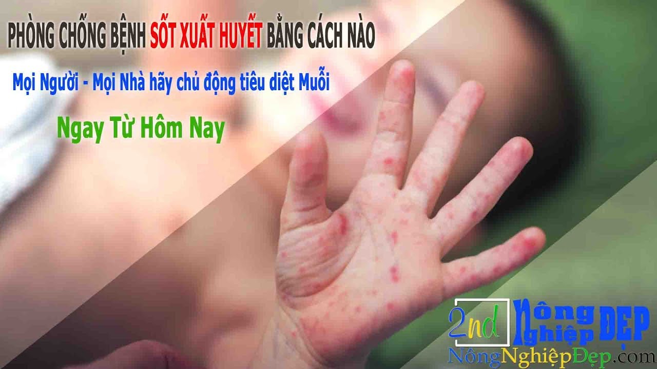 Phòng Tránh Bệnh SỐT XUẤT HUYẾT Cùng Chuyên Gia #Nông_Nghiệp_Đẹp