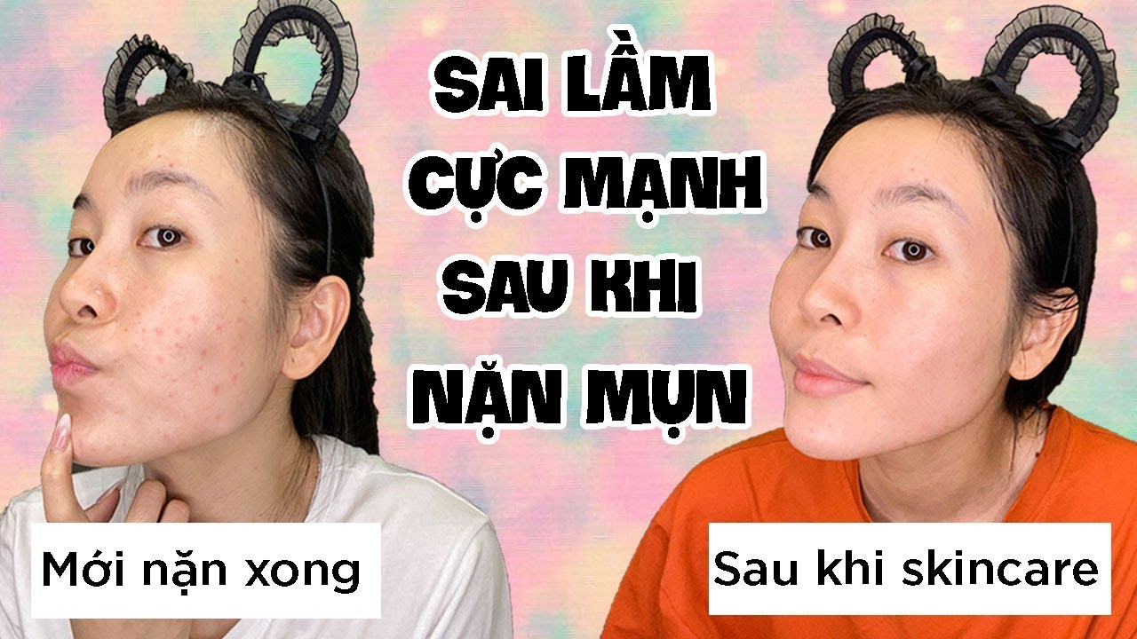 💛 Chăm Sóc Da ĐÚNG CÁCH sau nặn mụn | Sau nặn mụn cần làm gì? tránh gì để da ổn định !