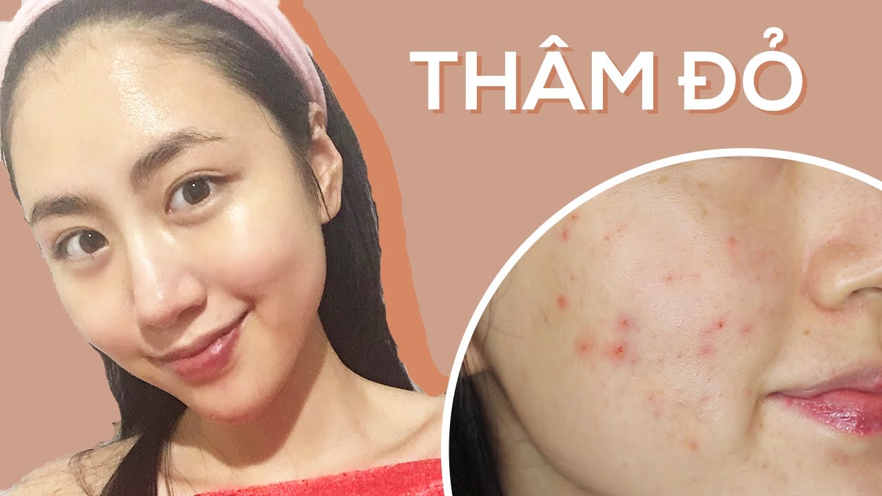 THÂM ĐỎ VÀ CUỘC CHIẾN ĐIỀU TRỊ CHÚNG LÀNH NHANH NHẤT | PIE – Post Inflammatory Erythema 101