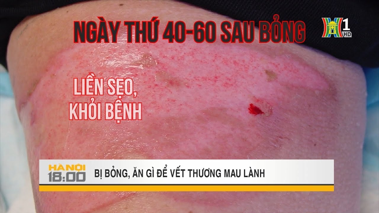 Bị bỏng ăn gì để vết thương mau lành | Sức khỏe đời sống | Mẹo vặt | Hà Nội 18:00