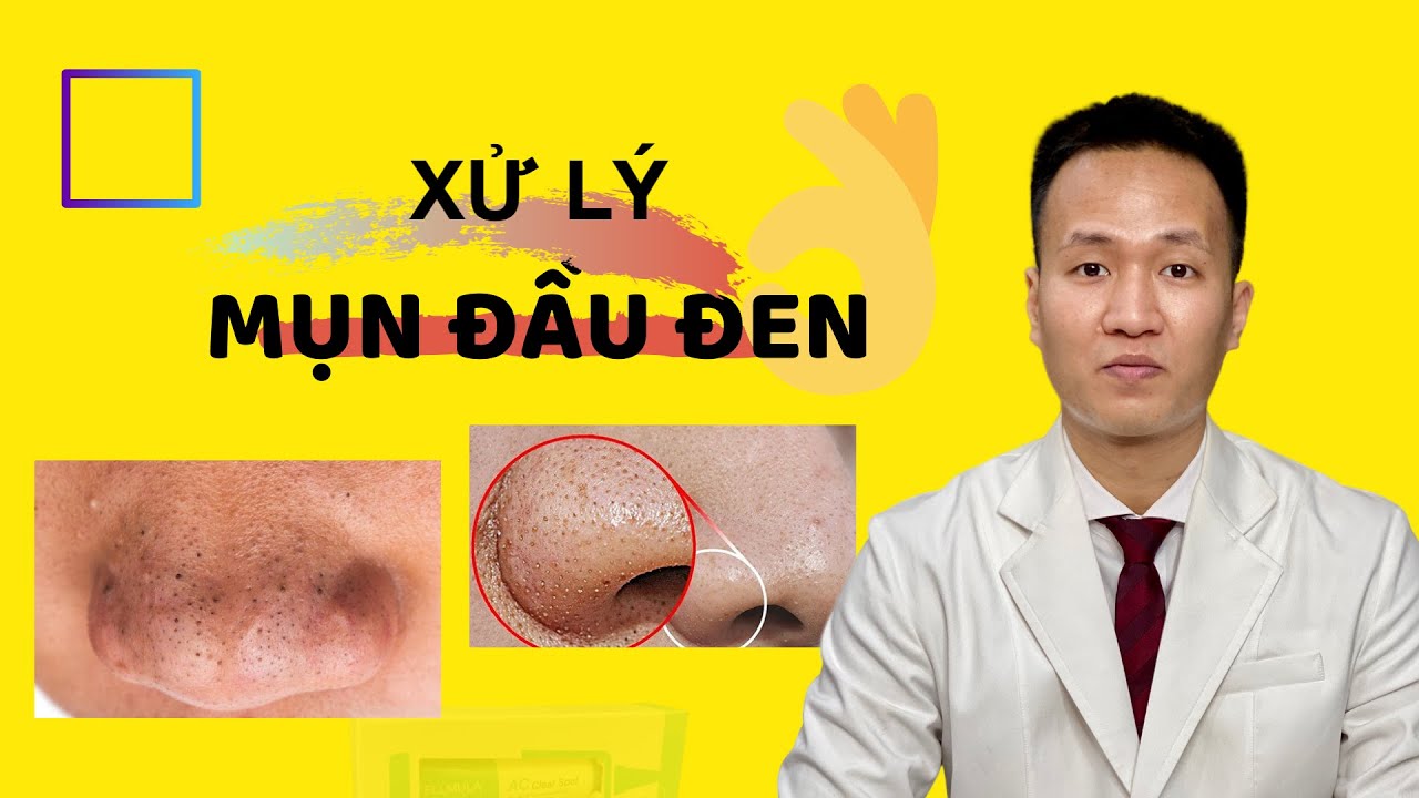 MỤN ẨN – MỤN ĐẦU ĐEN Cách phân biệt – hướng dẫn trị mụn ẨN – Mụn đầu đen tại nhà | Dr Hiếu