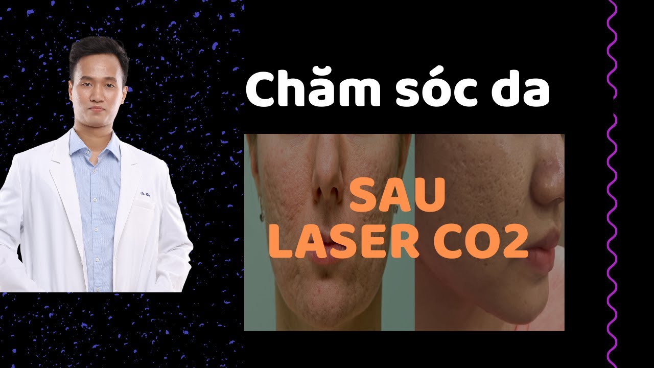 LASER CO2 – TRỊ SẸO – Hướng dẫn chăm sóc da ĐÚNG CÁCH sau Laser Co2 Fractional | Dr Hiếu