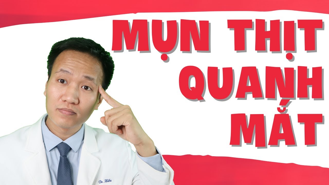 Mụn thịt quanh mắt| Dr Hiếu