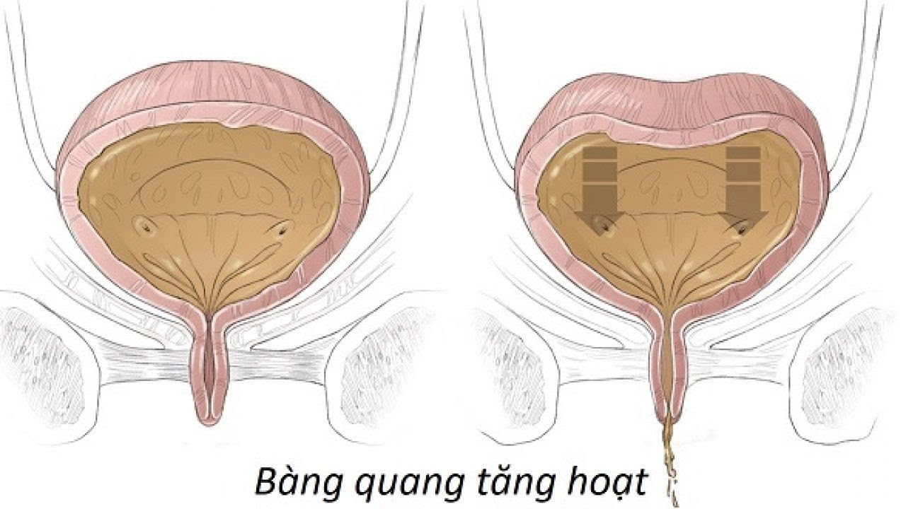 Hiểu đúng về bàng quang tăng hoạt | Sức khỏe vàng VTC16